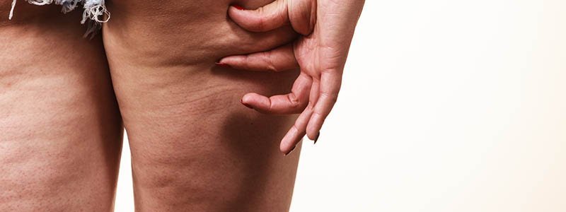 Cellulite behandeln