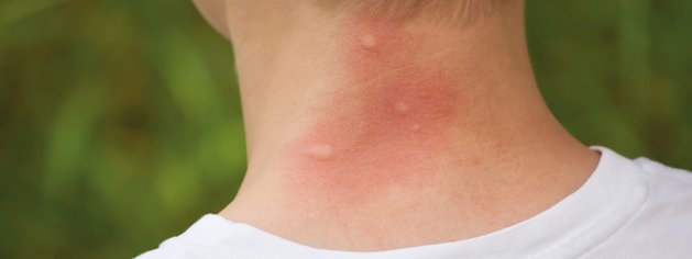 Mögen Mücken süsses Blut?